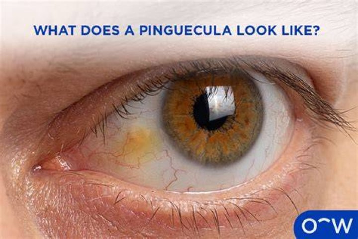 Can blue light cause pinguecula?