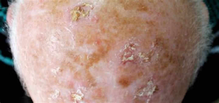 Can you cut off hyperkeratosis?