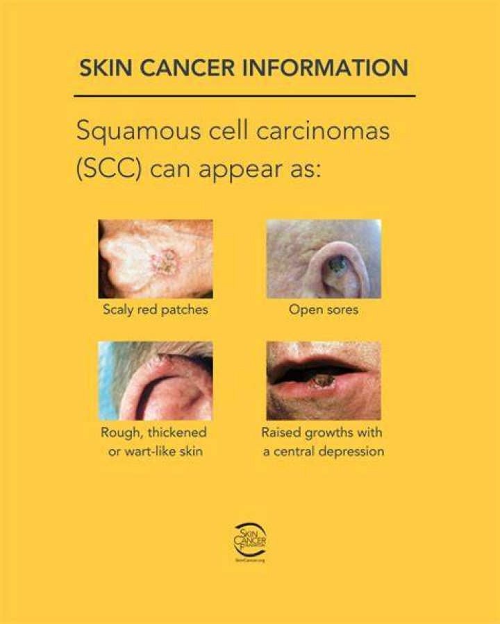 Is scc cancer dangerous?