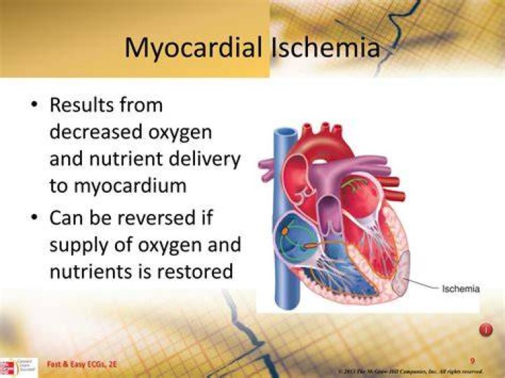 What is myocardial ischemia?