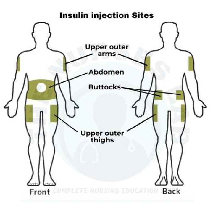 Where are insulin injection sites?